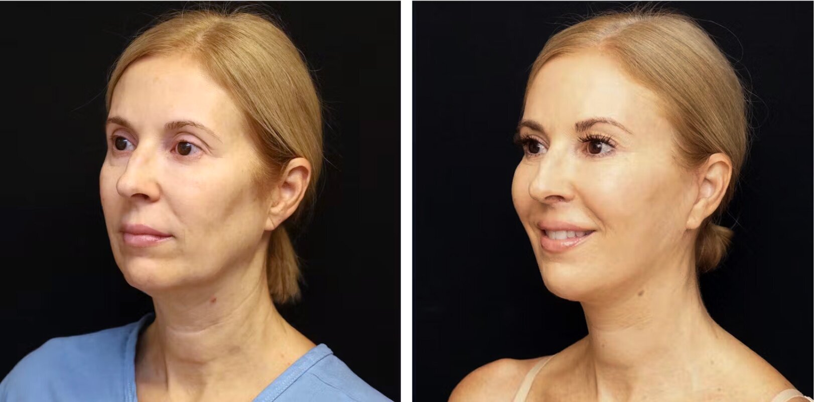 before-after